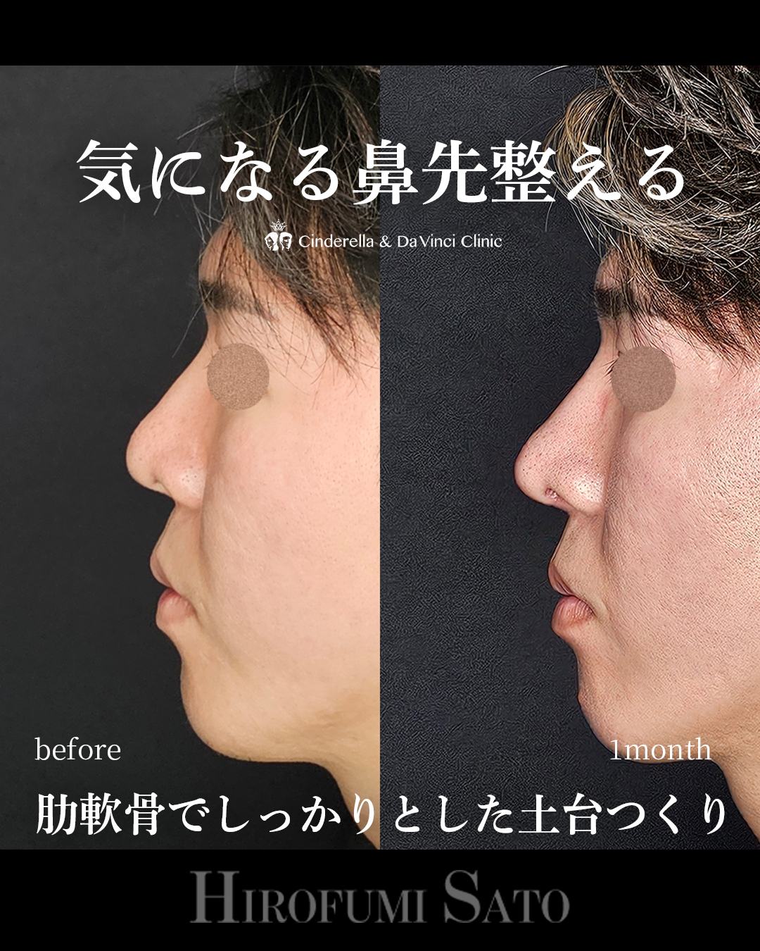 鼻先整えるの画像