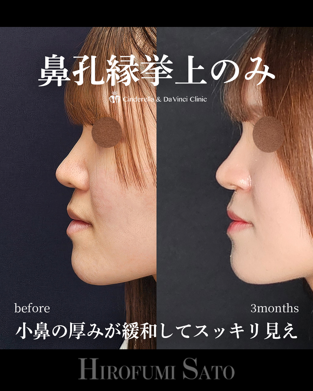 鼻孔縁挙上のみの画像