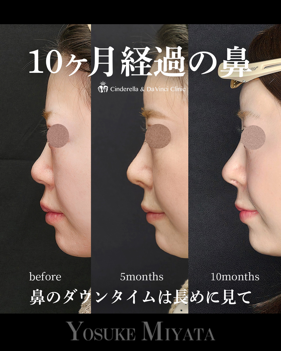 10ヶ月経過の鼻の画像