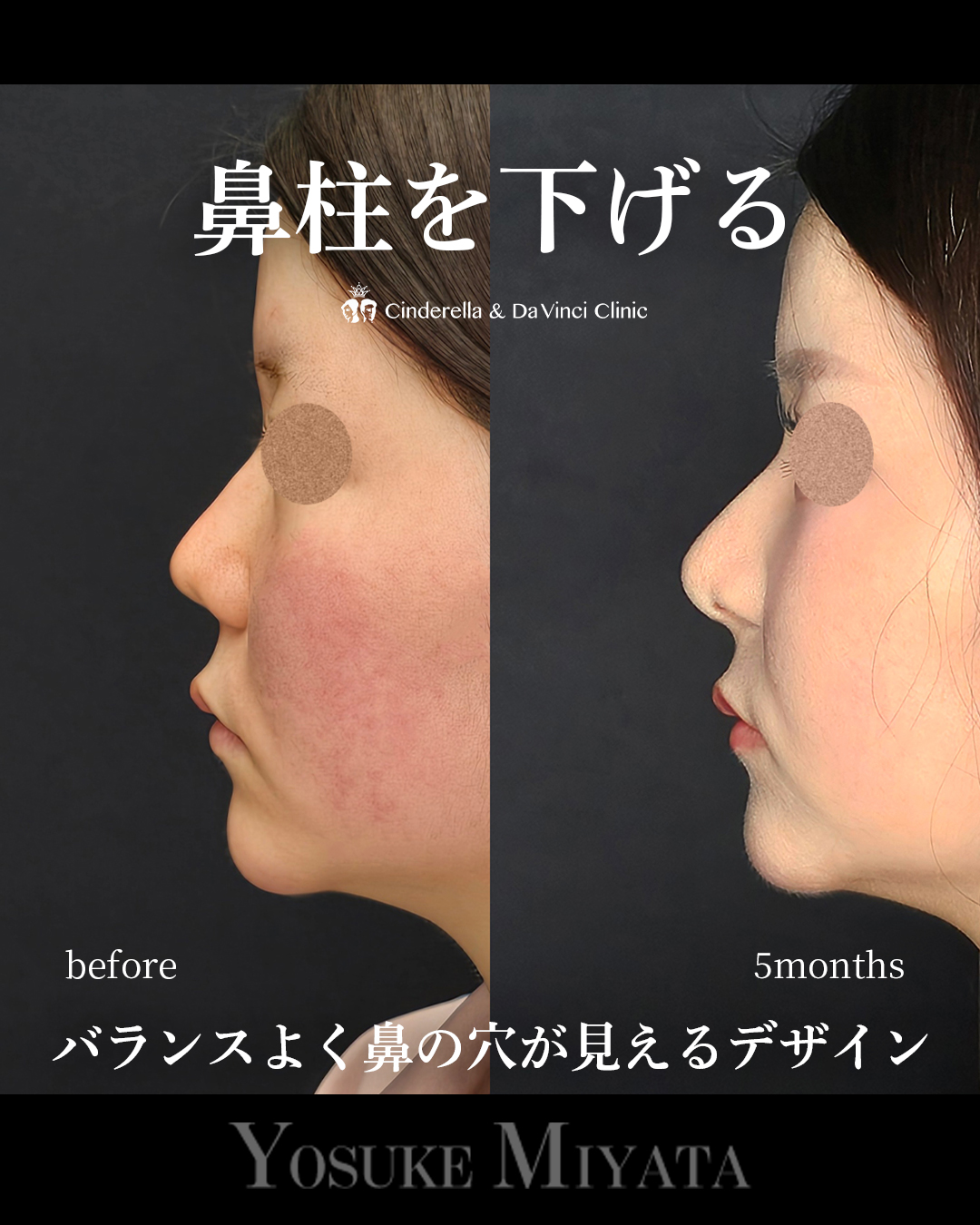 鼻柱を下げる鼻整形の画像