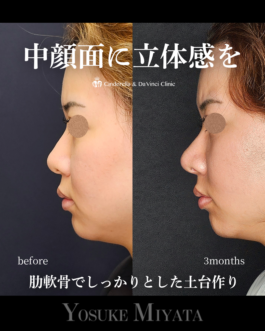 中顔面に立体感をの画像