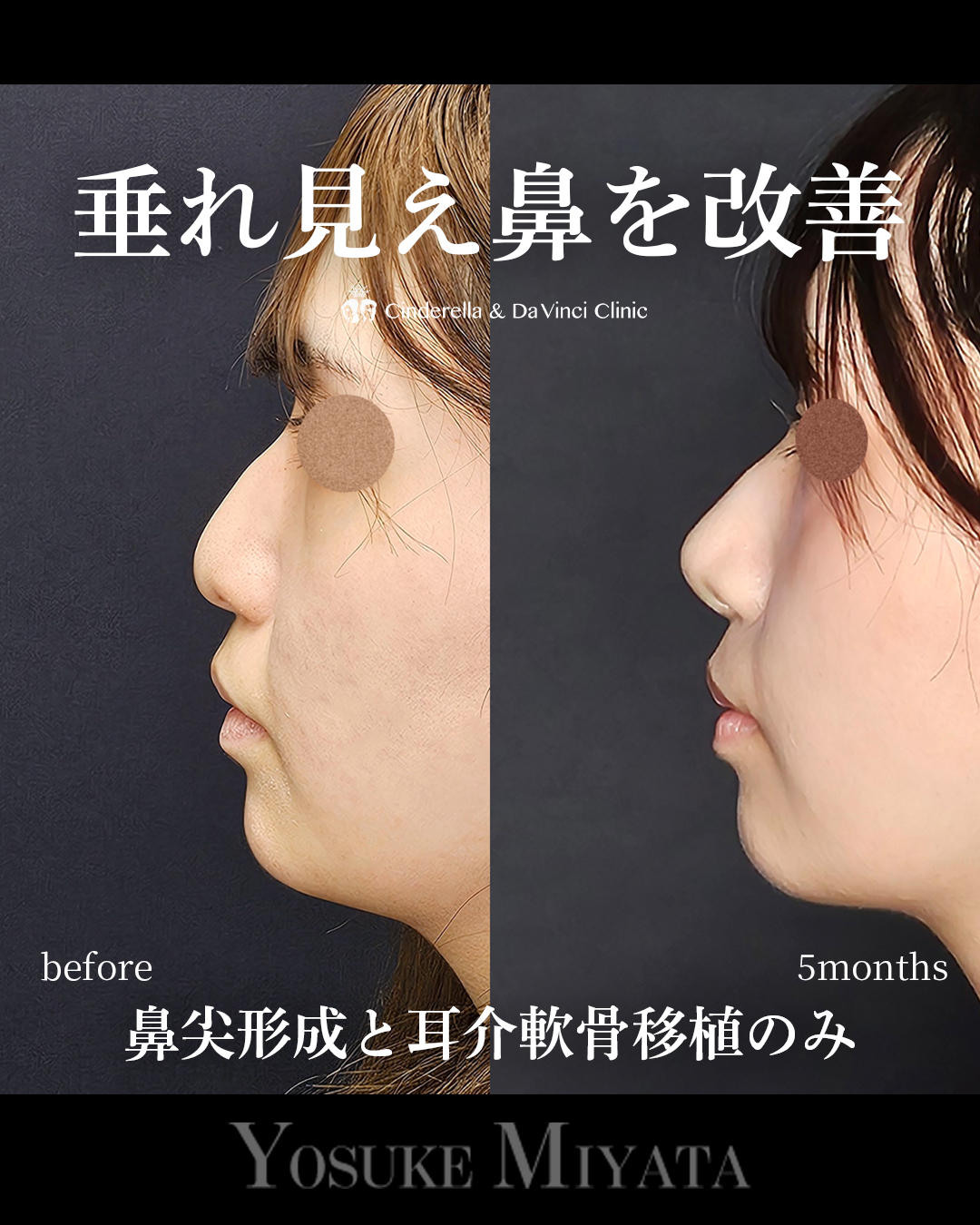 鼻先高く垂れ改善の画像