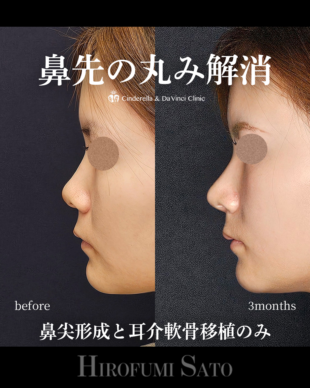 鼻先の丸み改善の画像