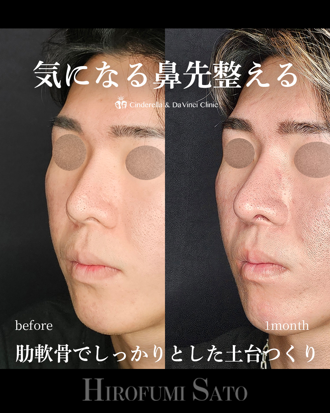 鼻先整えるの画像