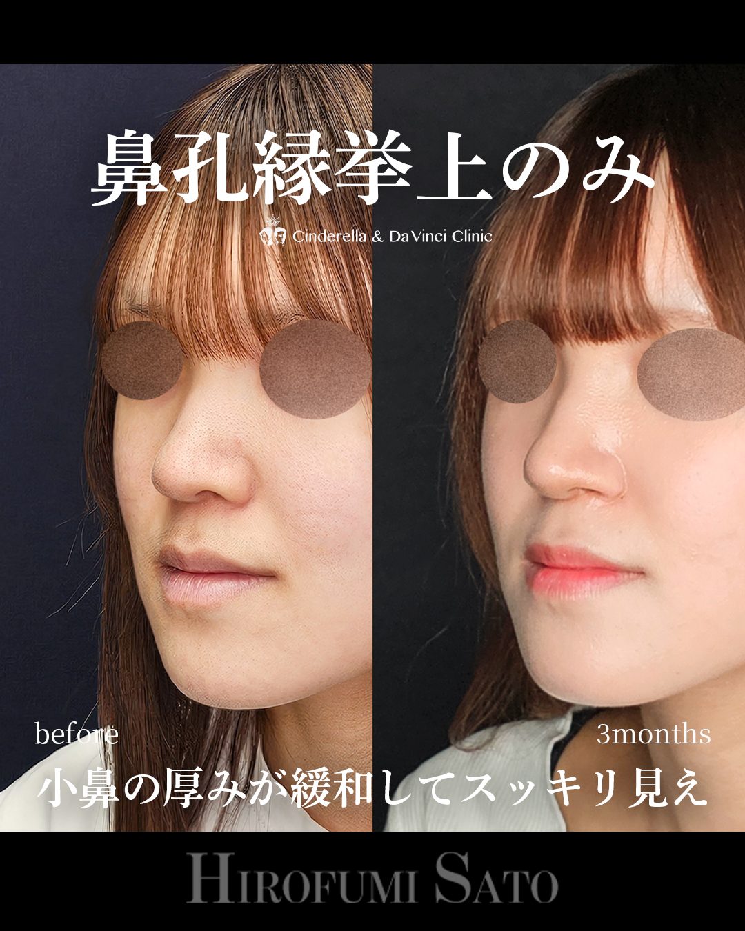 鼻孔縁挙上のみの画像