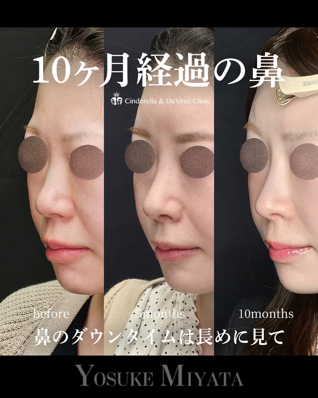 10ヶ月経過の鼻の画像