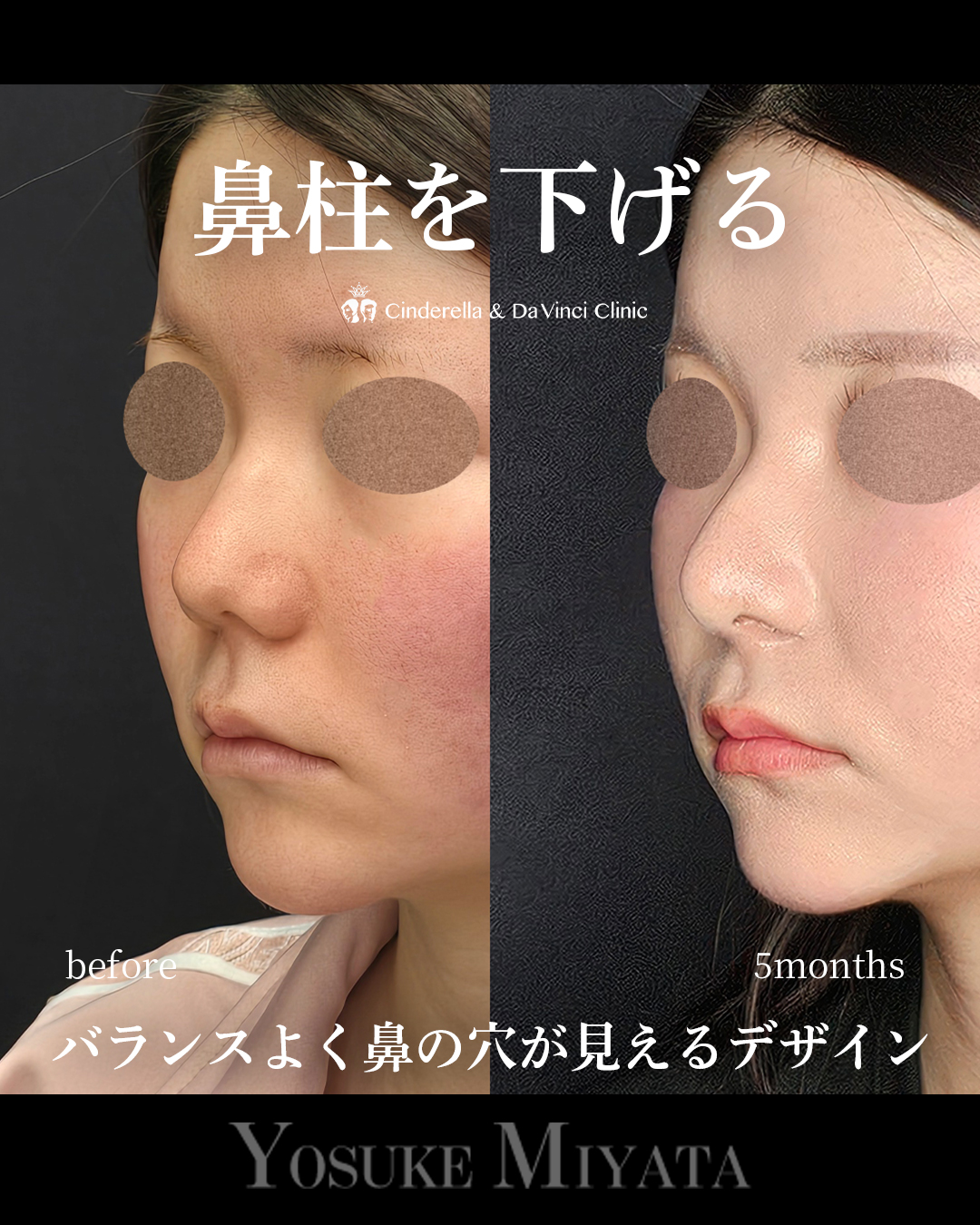 鼻柱を下げる鼻整形の画像