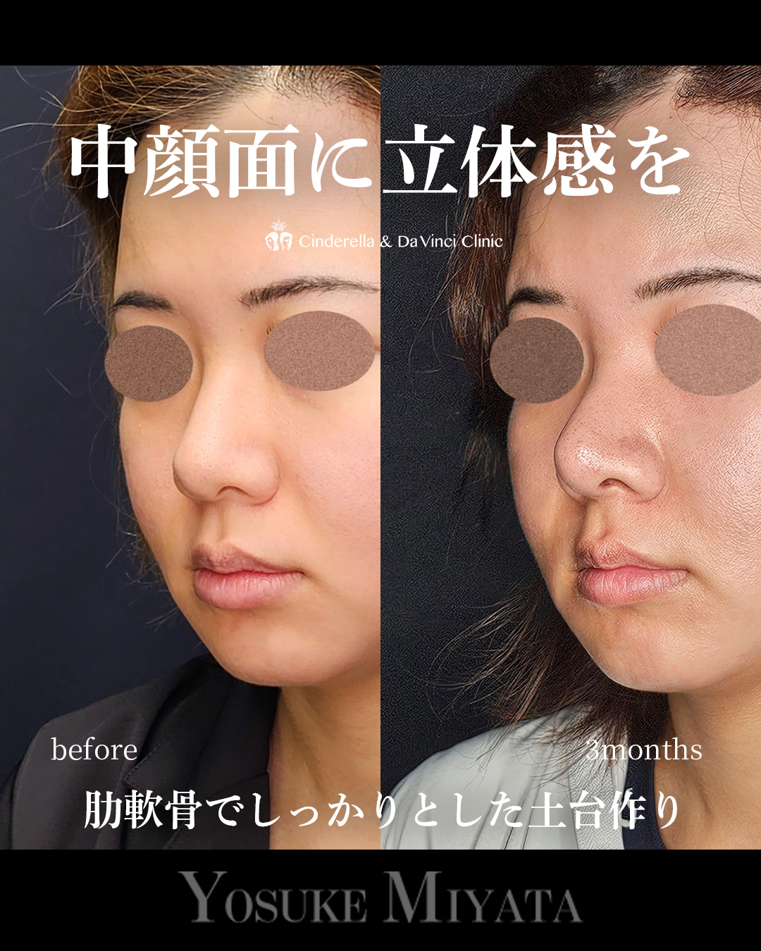 中顔面に立体感をの画像