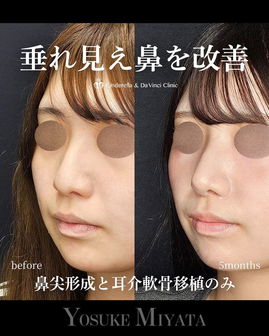 鼻先高く垂れ改善の画像