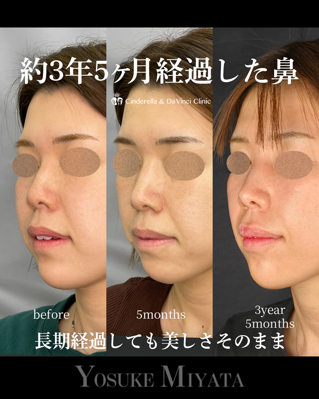 鼻の長期経過の画像