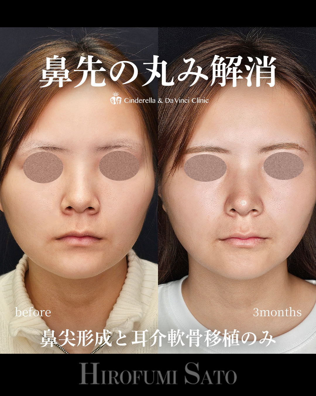 鼻先の丸み改善の画像
