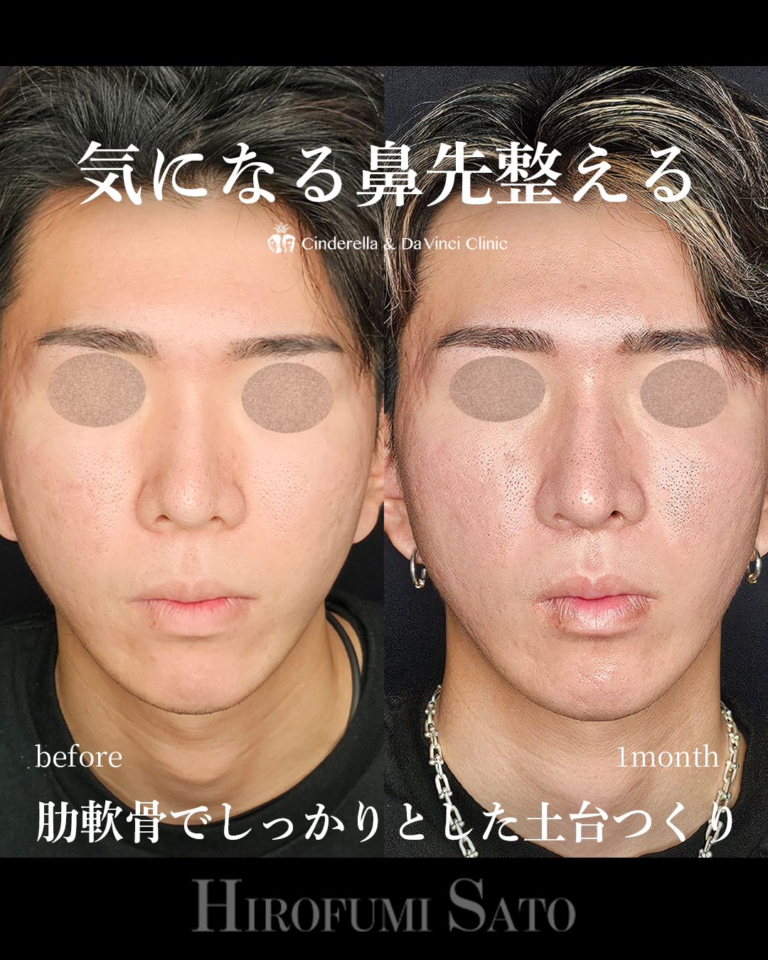 鼻先整えるの画像