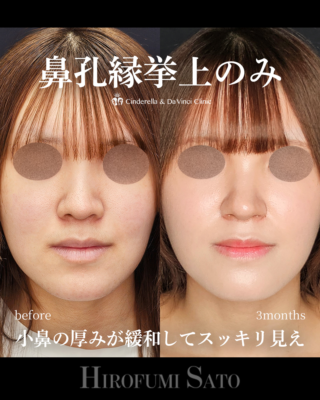鼻孔縁挙上のみの画像