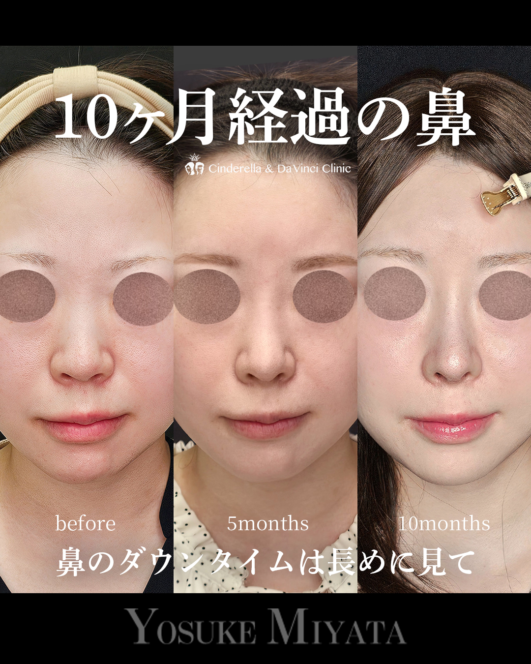10ヶ月経過の鼻の画像
