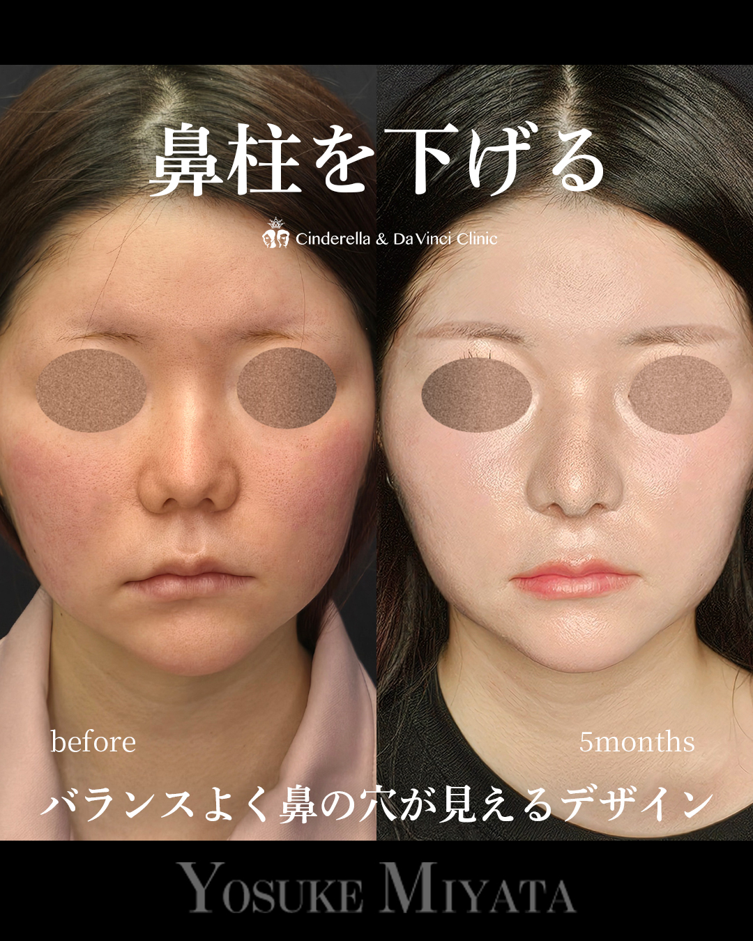 鼻柱を下げる鼻整形の画像