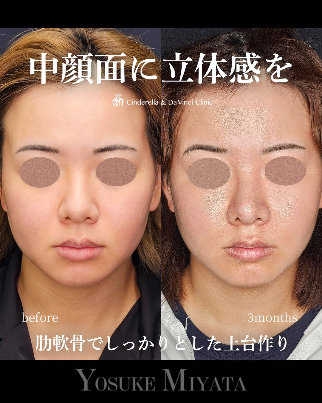 中顔面に立体感をの画像