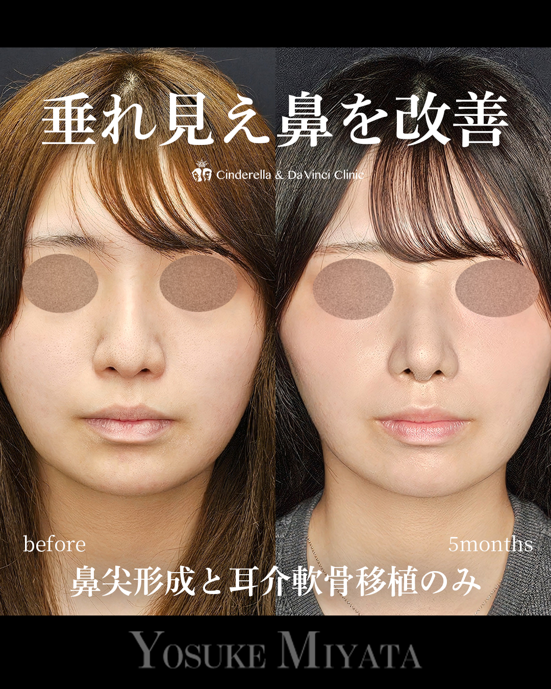 鼻先高く垂れ改善の画像
