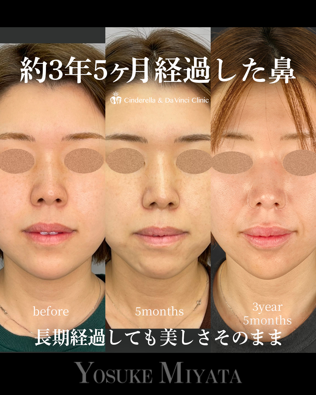 鼻の長期経過の画像