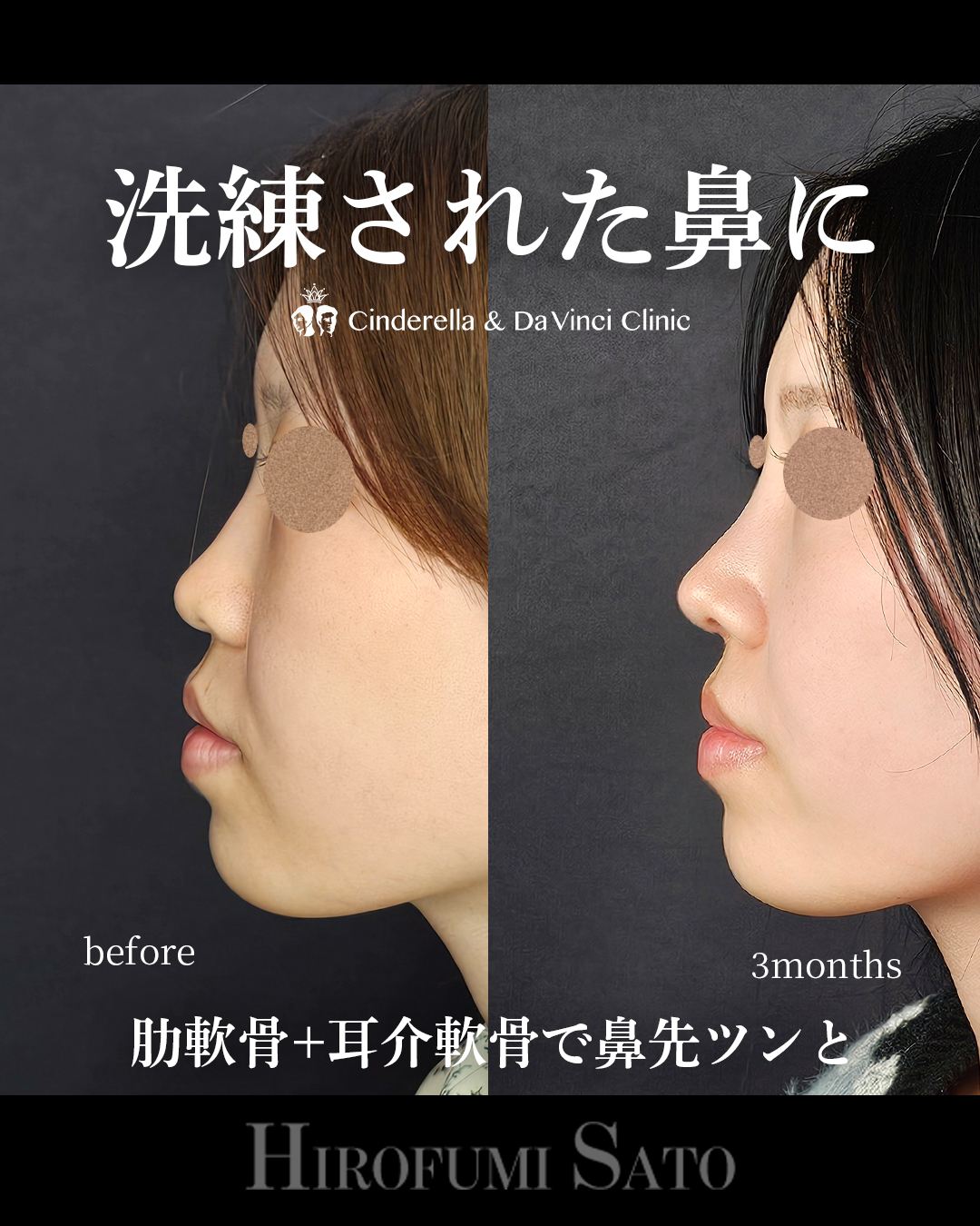 小鼻縮小なしで小鼻を小さくの画像