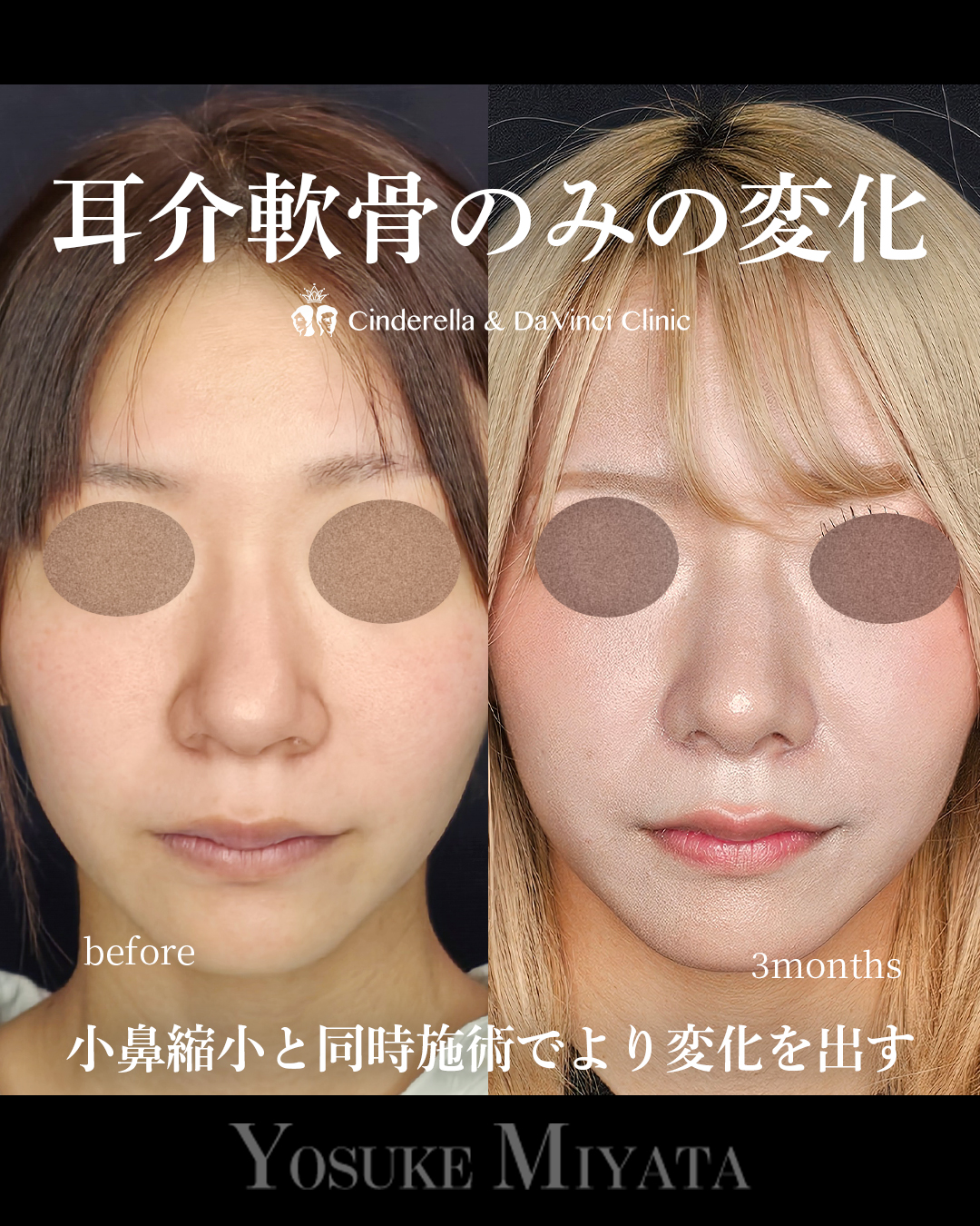 鼻先と小鼻同時手術の画像