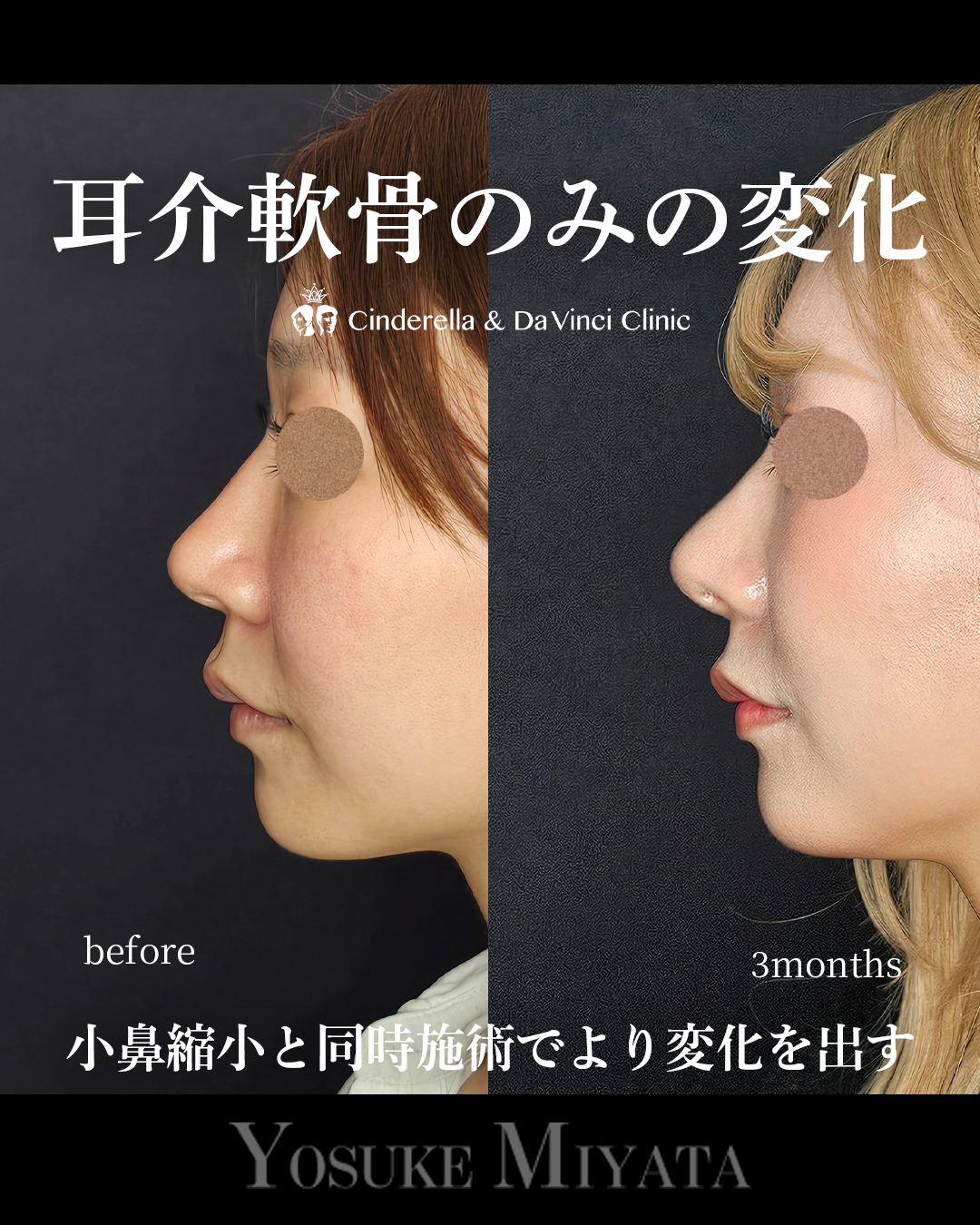 鼻先と小鼻同時手術の画像