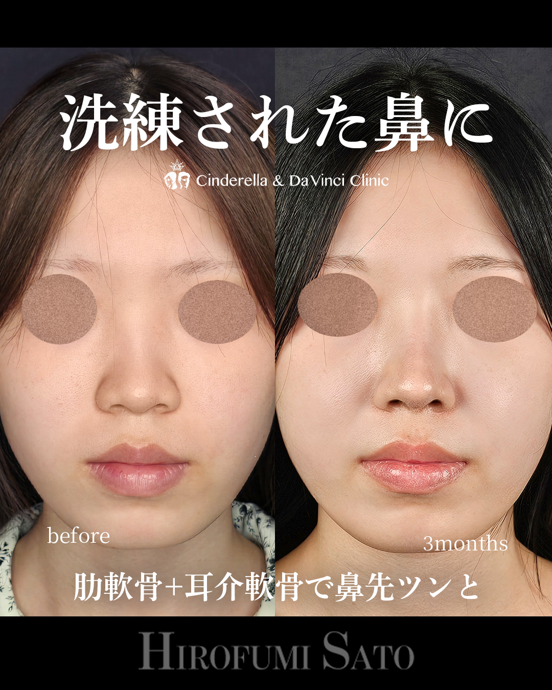 小鼻縮小なしで小鼻を小さくの画像