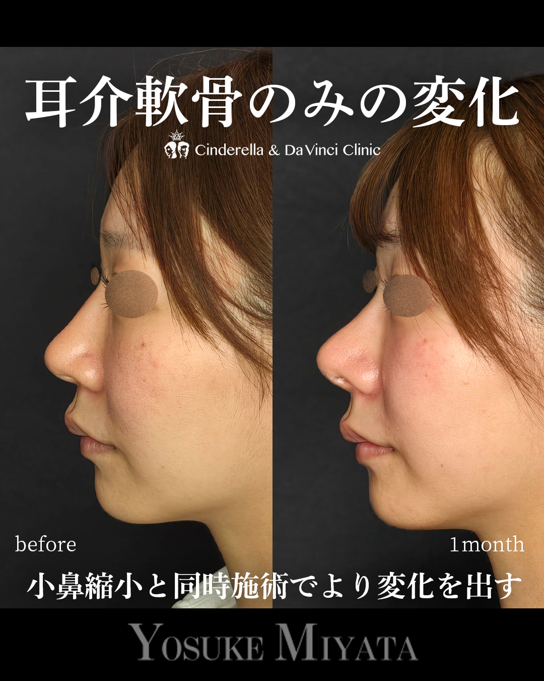 鼻先と小鼻同時手術の画像