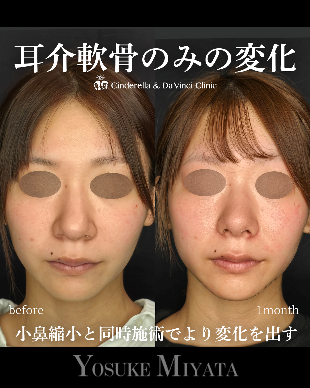 鼻先と小鼻同時手術の画像