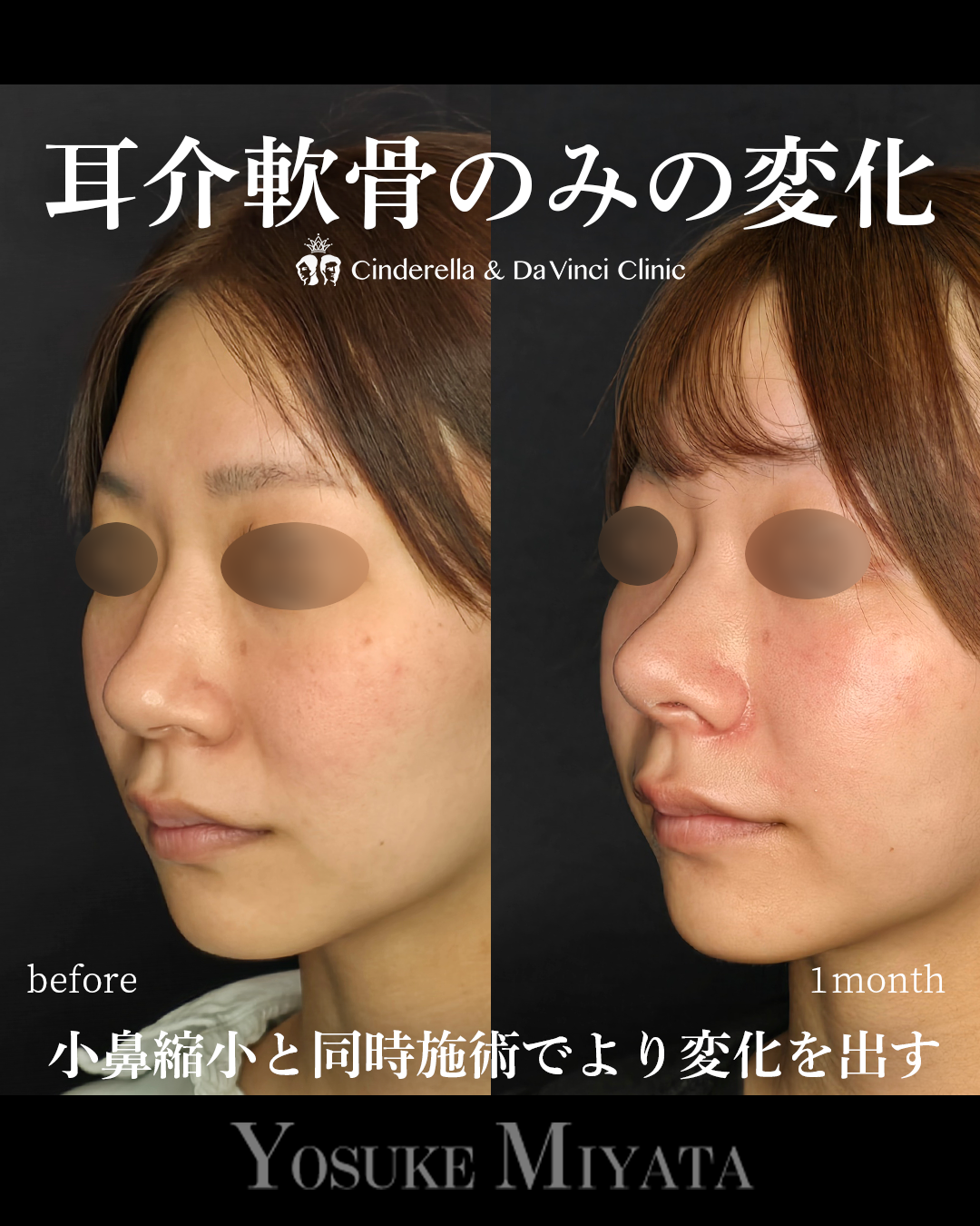 鼻先と小鼻同時手術の画像