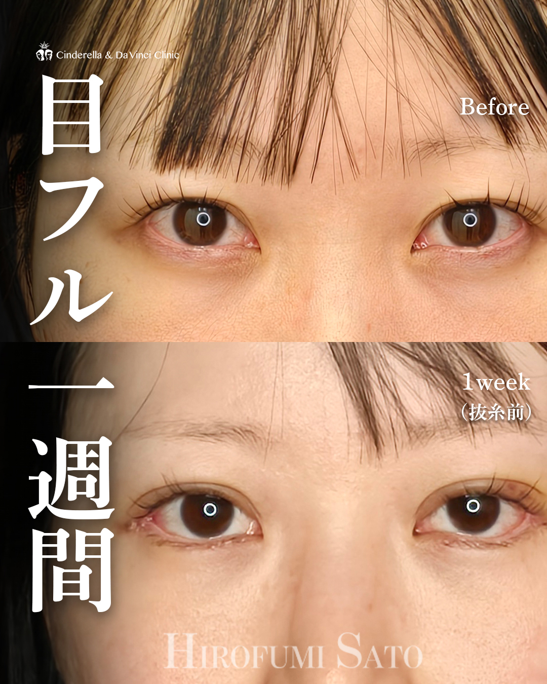 目フルから一週間の画像