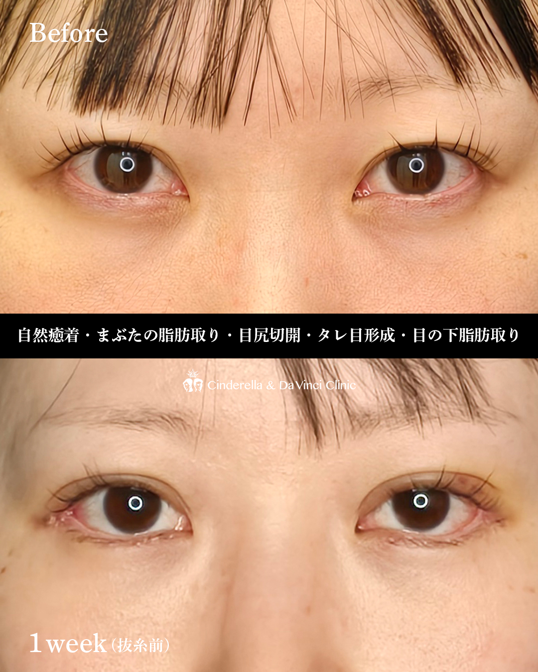 目フルから一週間の画像