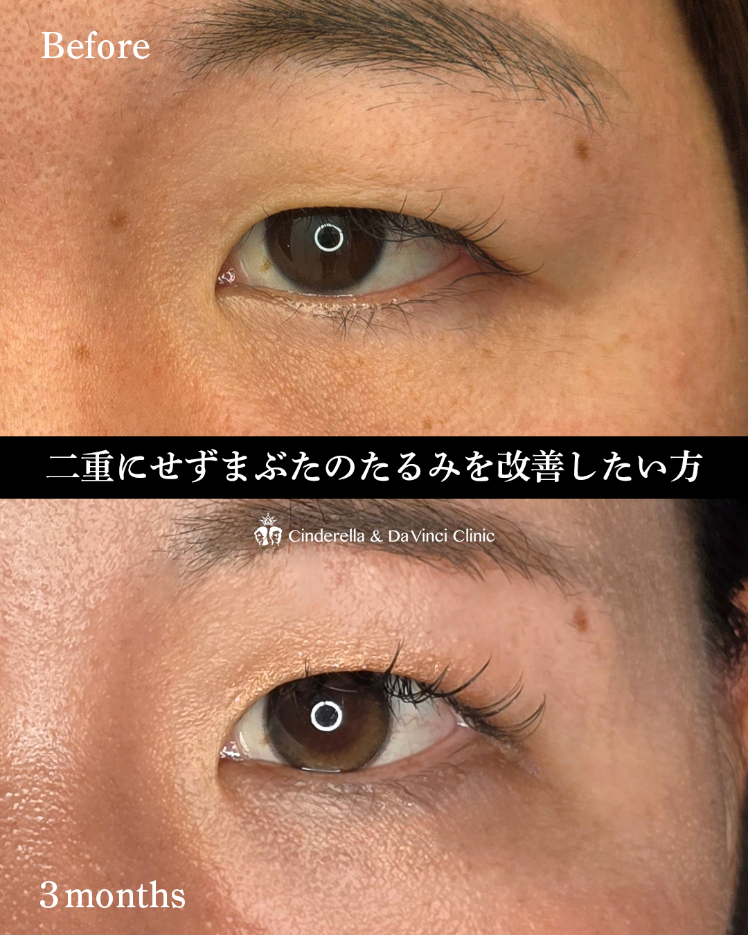 まぶたの厚み改善の画像