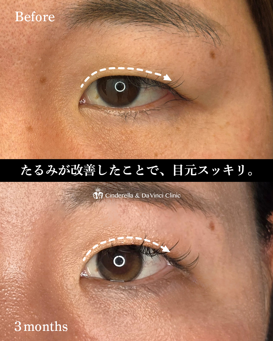 まぶたの厚み改善の画像