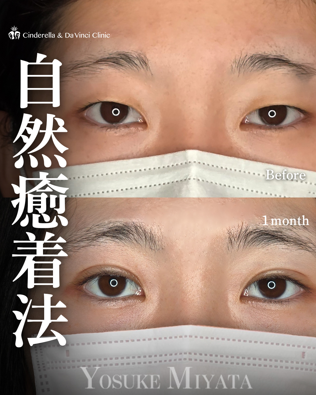 自然癒着でまつげの生え際を見せるの画像