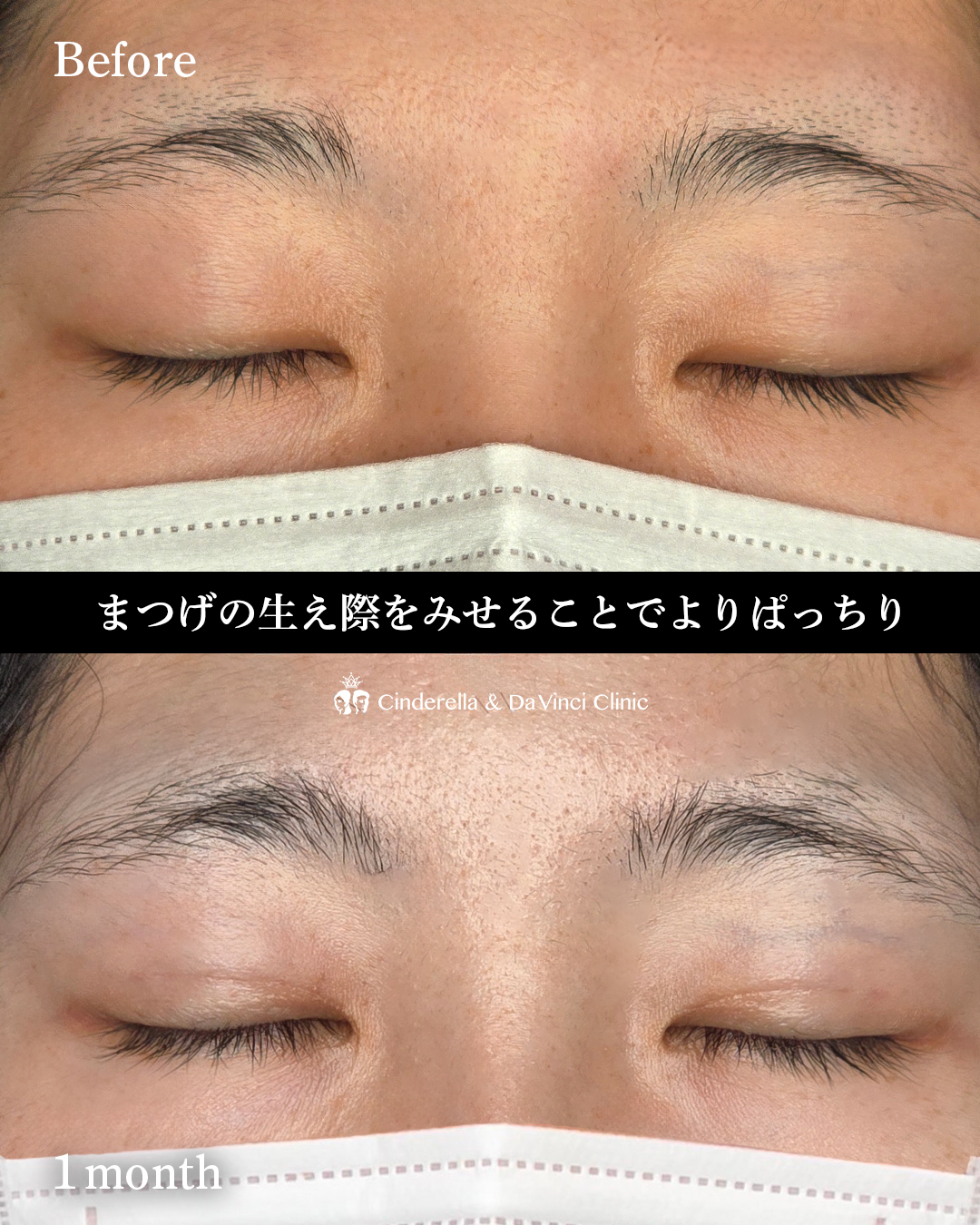 自然癒着でまつげの生え際を見せるの画像