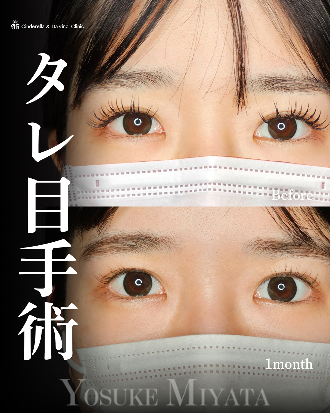 目を大きくするの画像