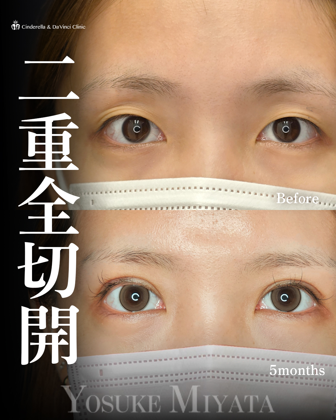 切開でつくる二重の画像