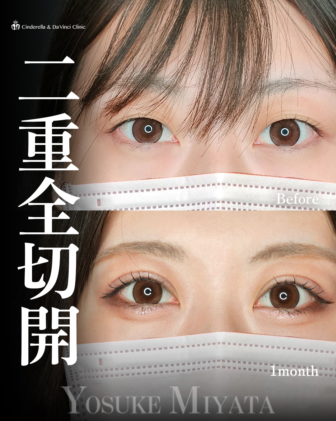 くっきり二重の画像