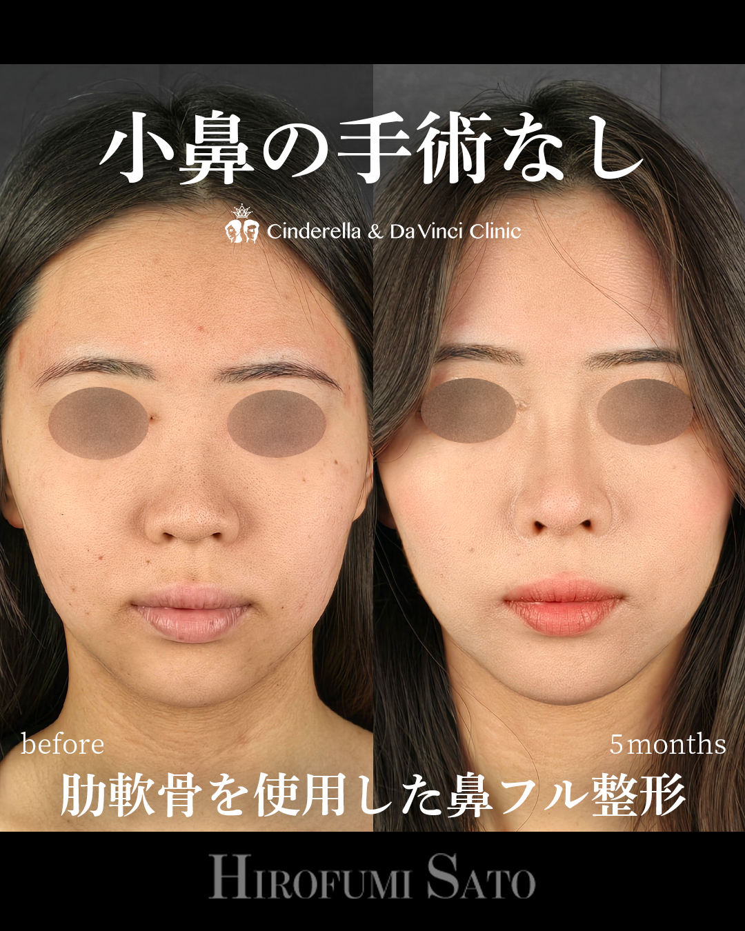 小鼻の手術なしの画像