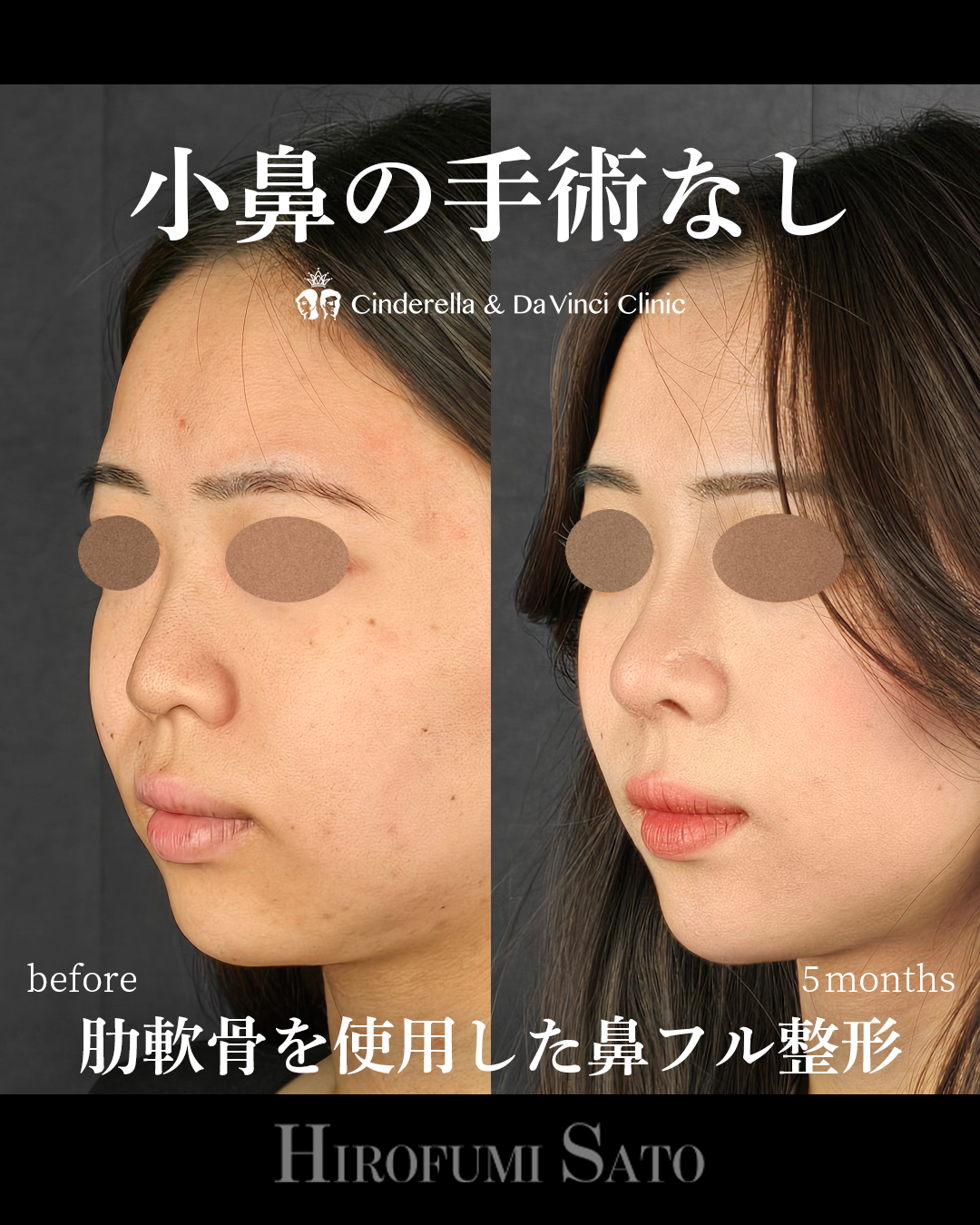 小鼻の手術なしの画像