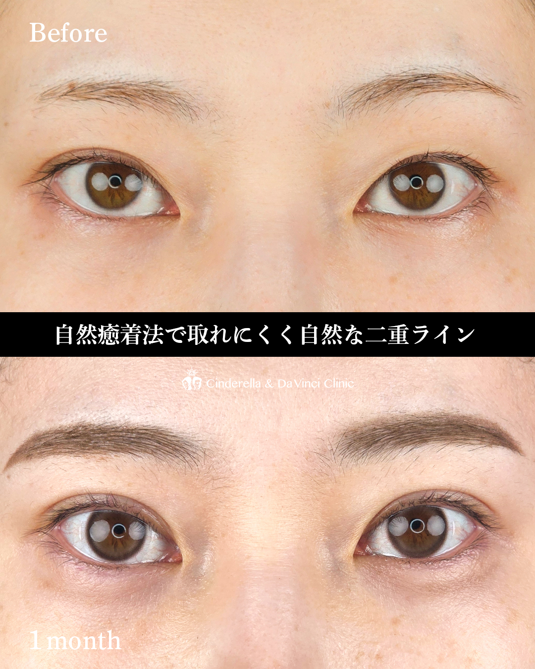 埋没は自然癒着法での画像