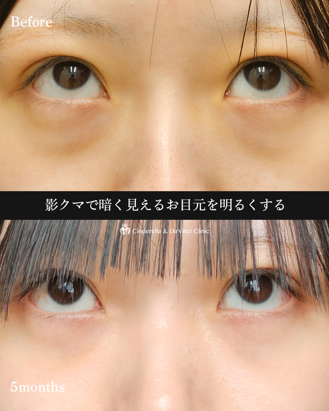 影クマ改善の画像