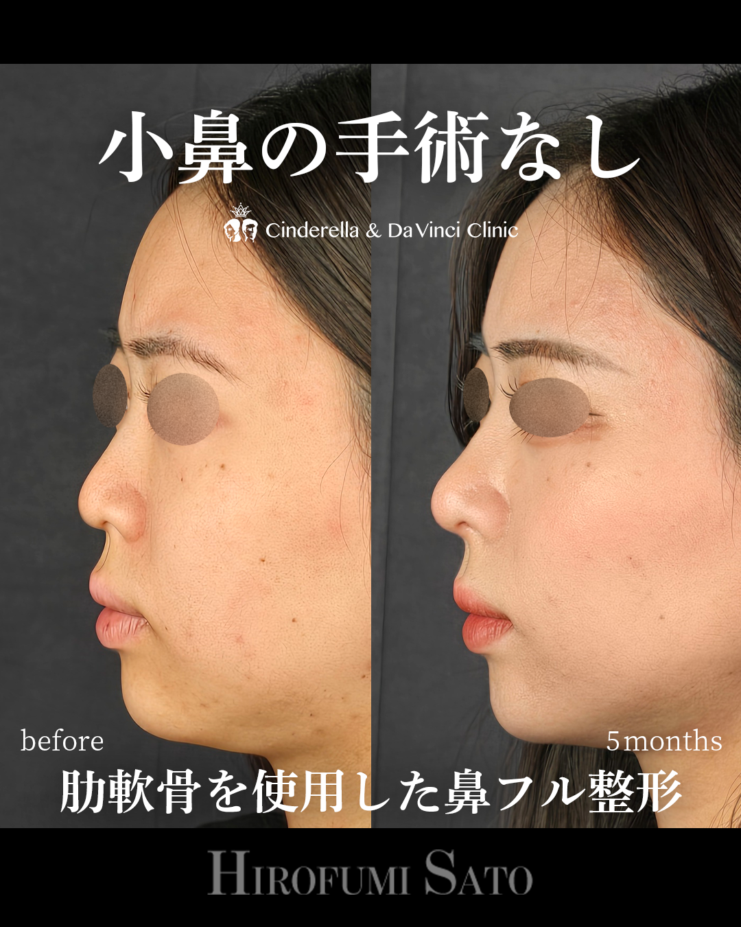 小鼻の手術なしの画像