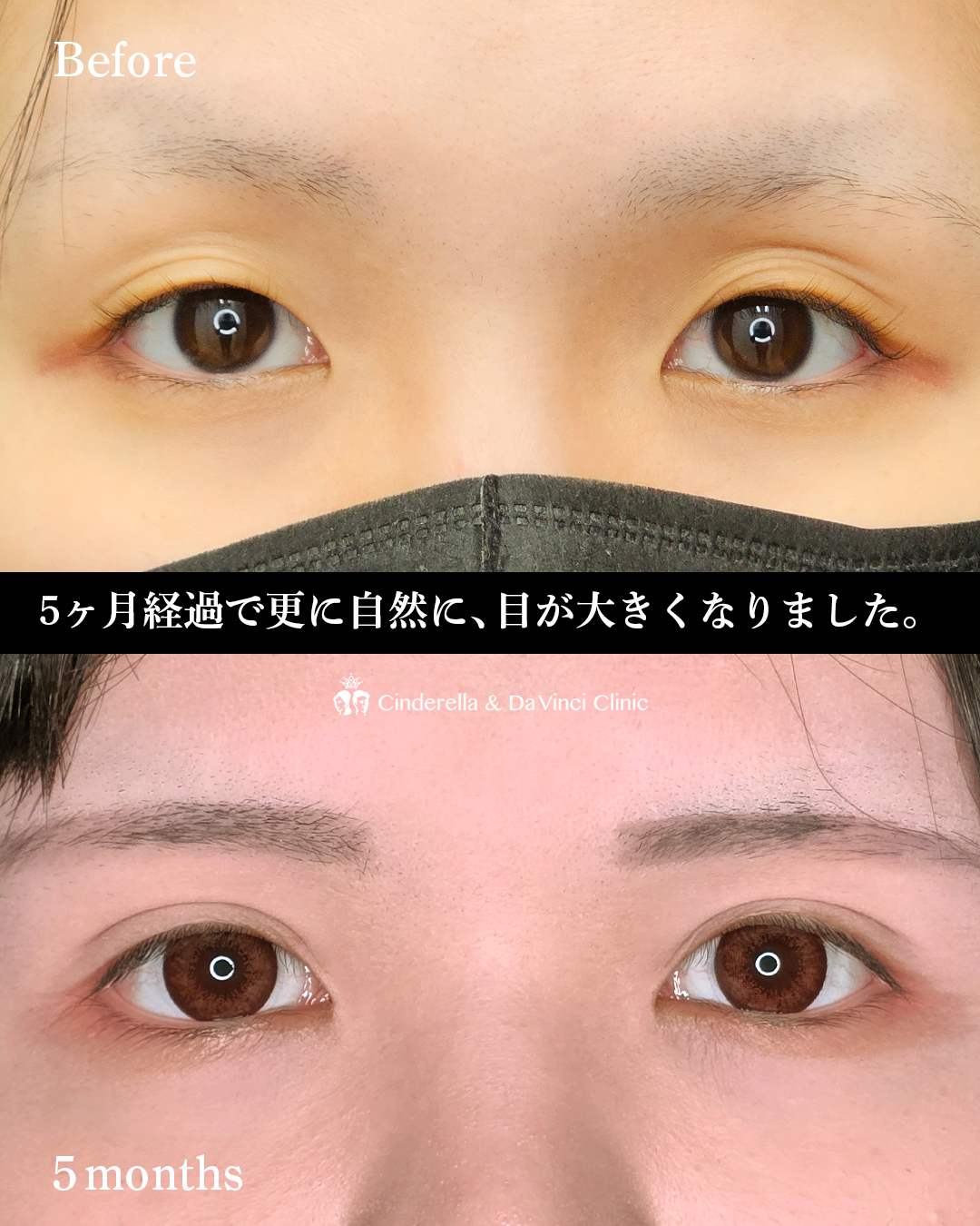 目を大きくするの画像