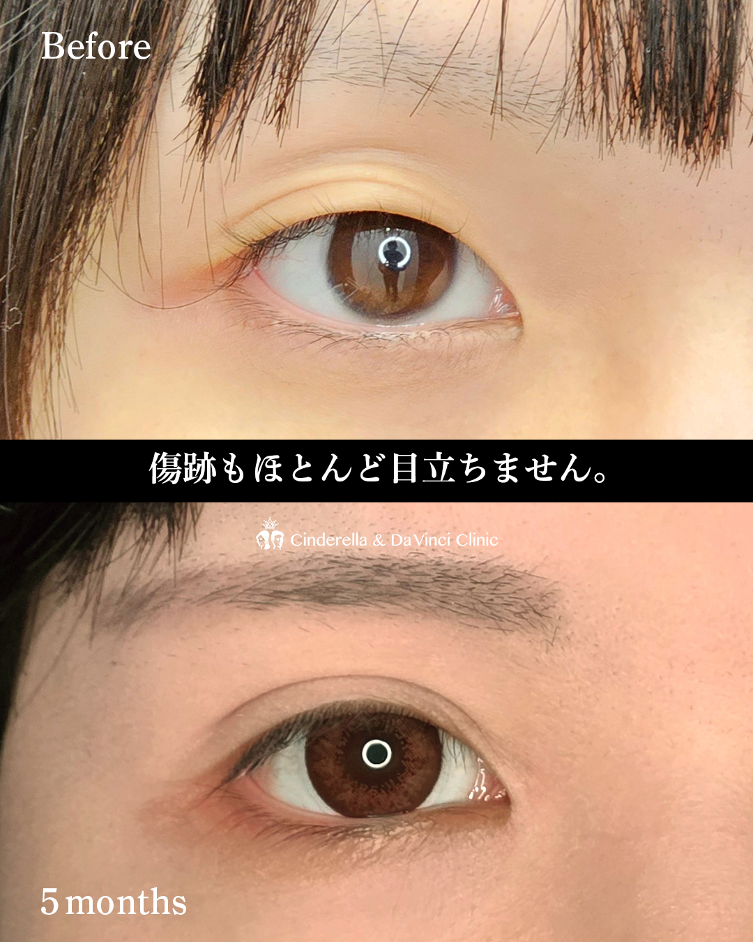 目を大きくするの画像