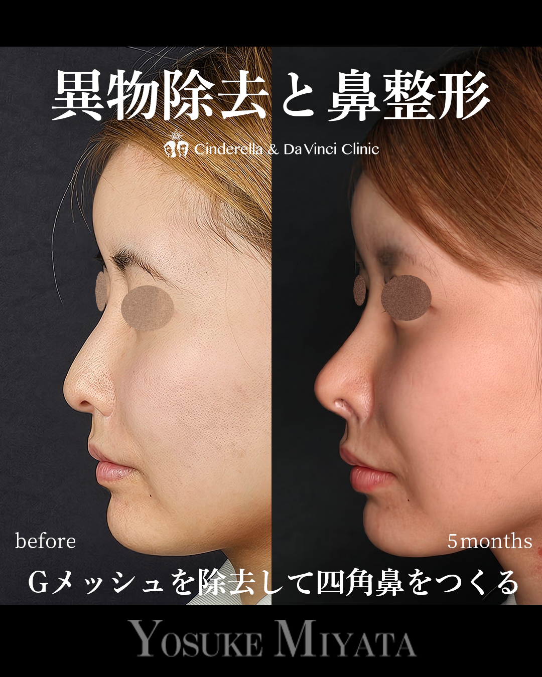 Gメッシュ除去と鼻整形の画像