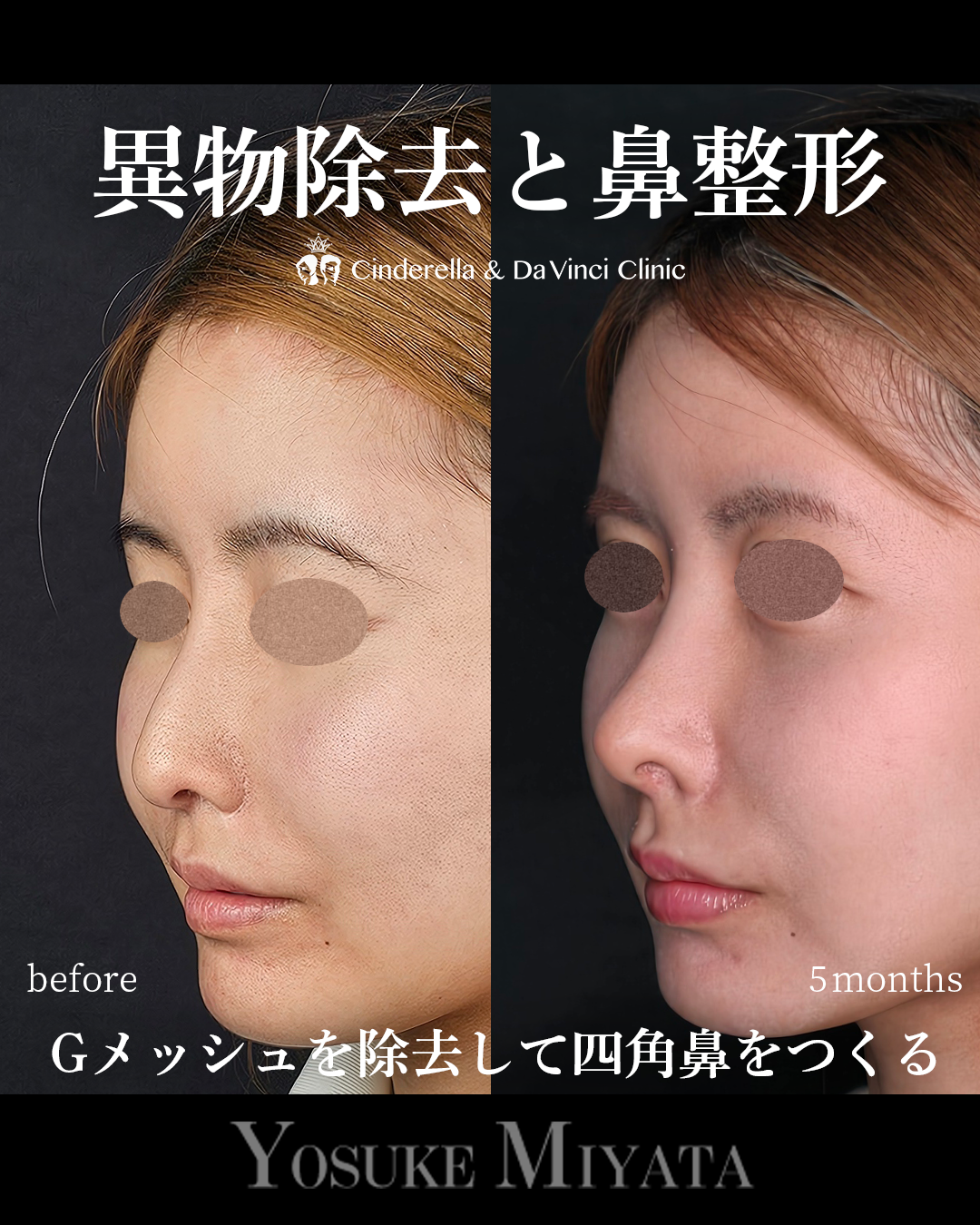 Gメッシュ除去と鼻整形の画像