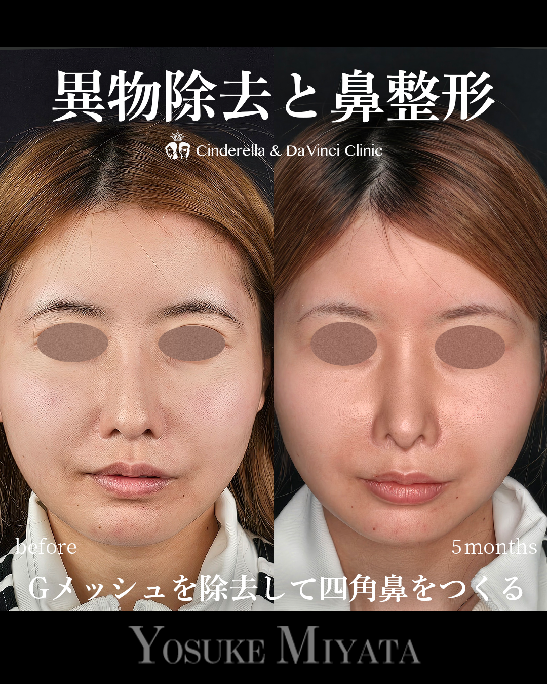 Gメッシュ除去と鼻整形の画像