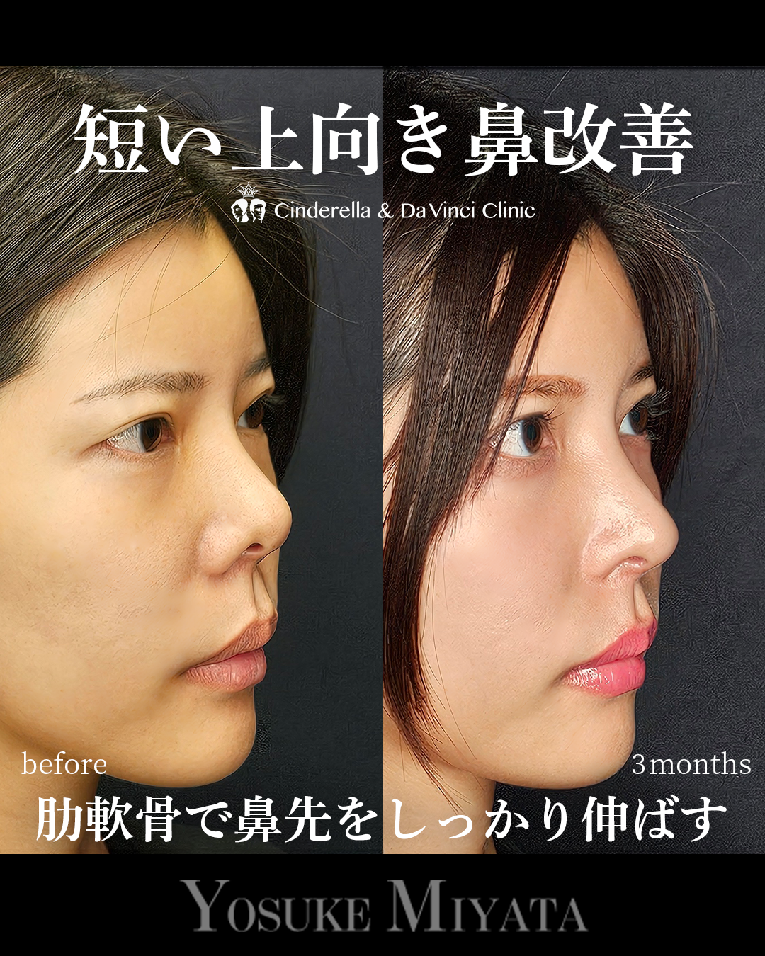 短い上向き鼻を下に伸ばすの画像