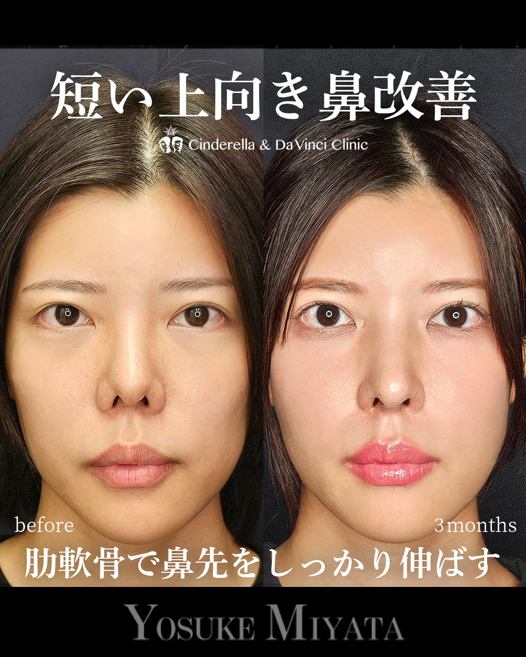 短い上向き鼻を下に伸ばすの画像